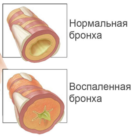 Аллергический бронхит