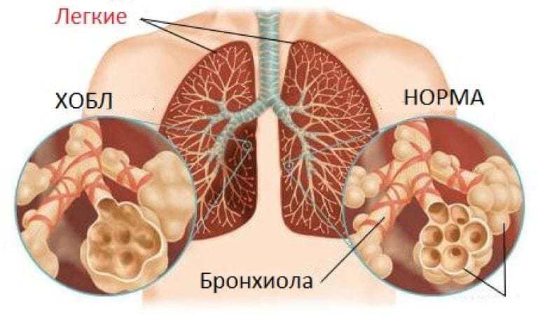 Хроническая обструктивная болезнь легких 